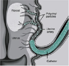fibroma uterino3