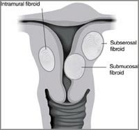fibroma uterino1